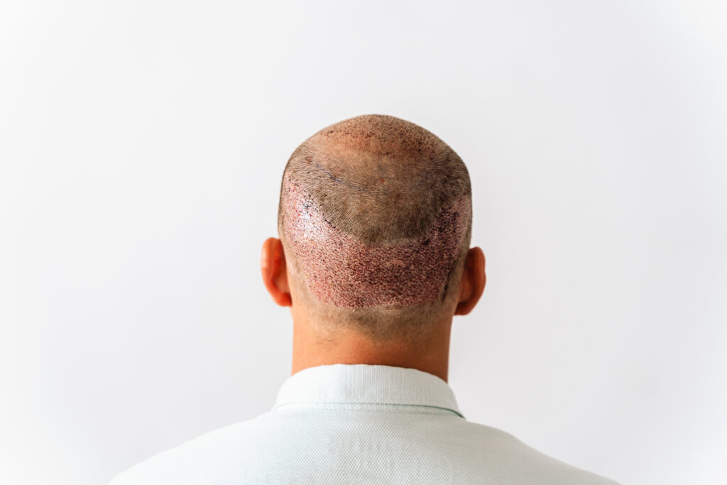 Scalp Micropigmentation for Scars