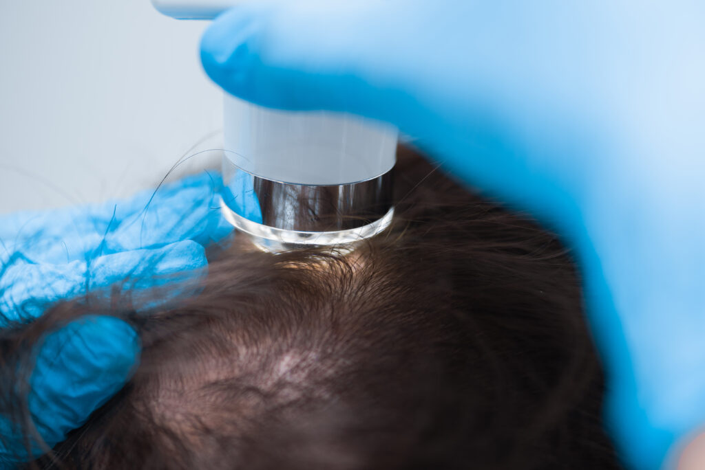 3D Scalp Micropigmentation