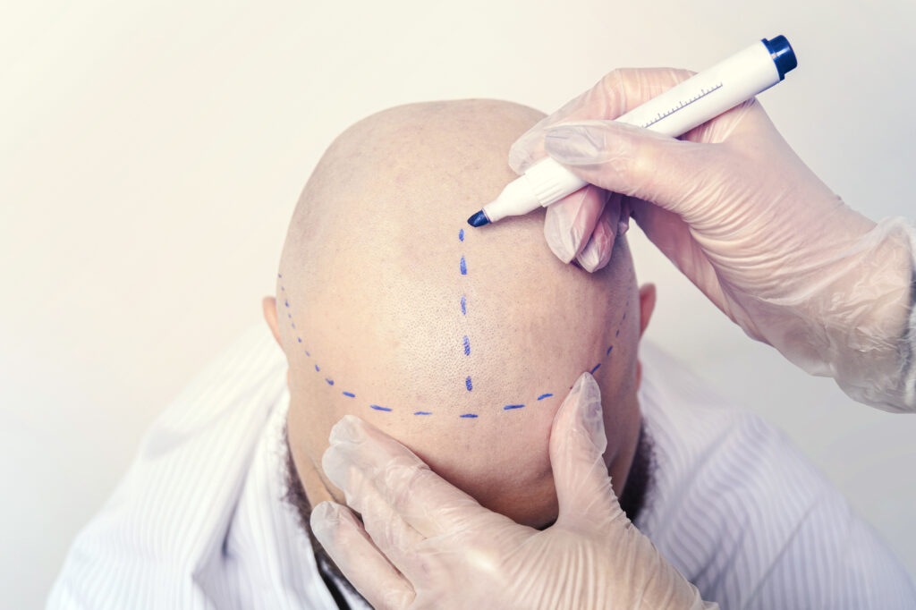 How long does Scalp Micropigmentation take?
