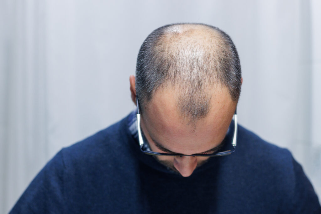 Scalp Micropigmentation for Alopecia